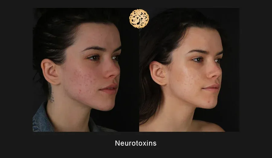 Neurotoxins Before & After
