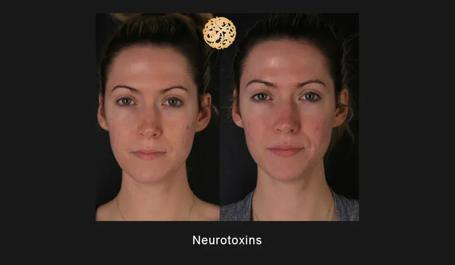 Neurotoxins Before & After