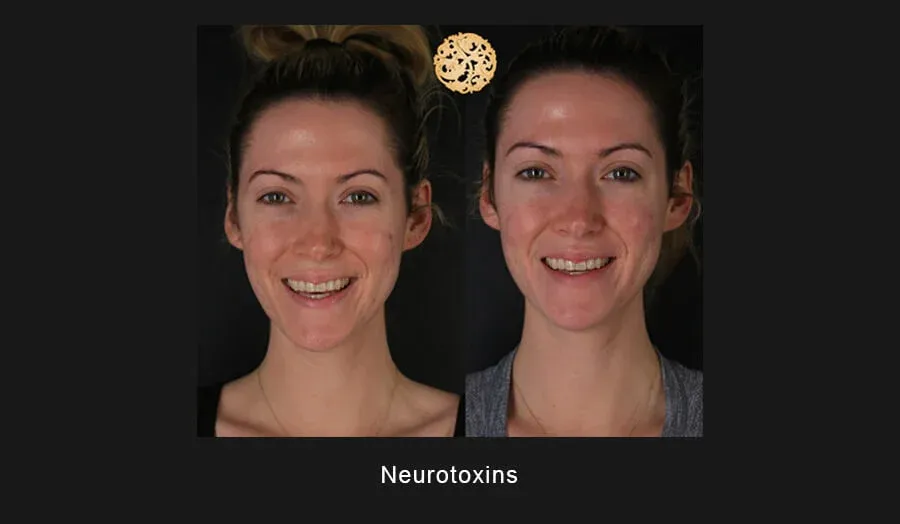 Neurotoxins Before & After