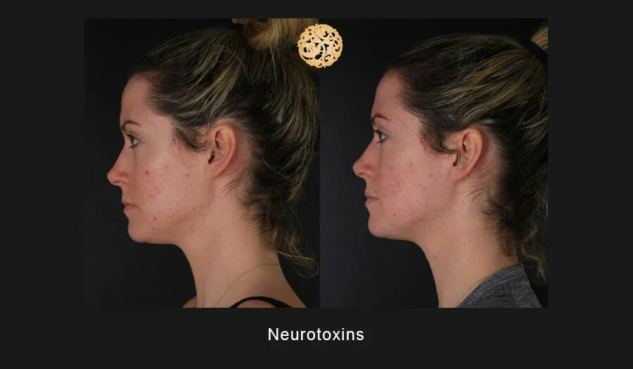 Neurotoxins Before & After