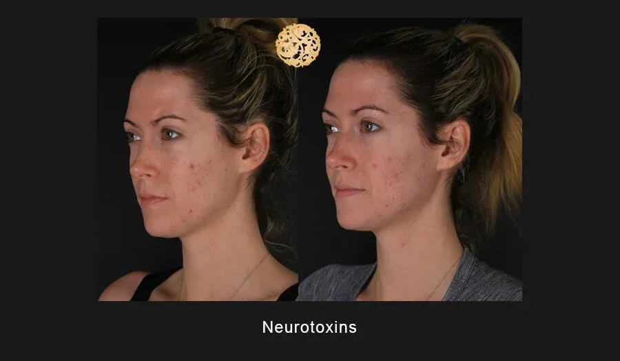 Neurotoxins Before & After