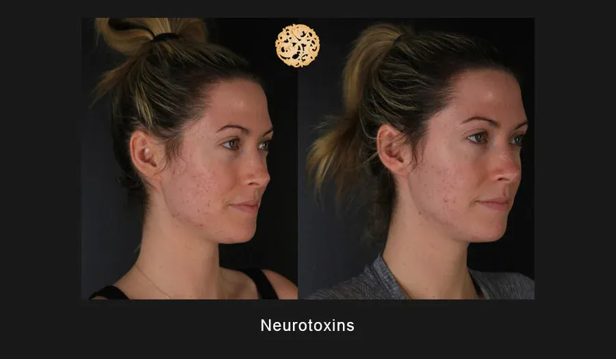 Neurotoxins Before & After