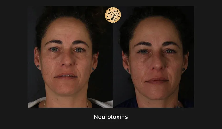 Neurotoxins Before & After