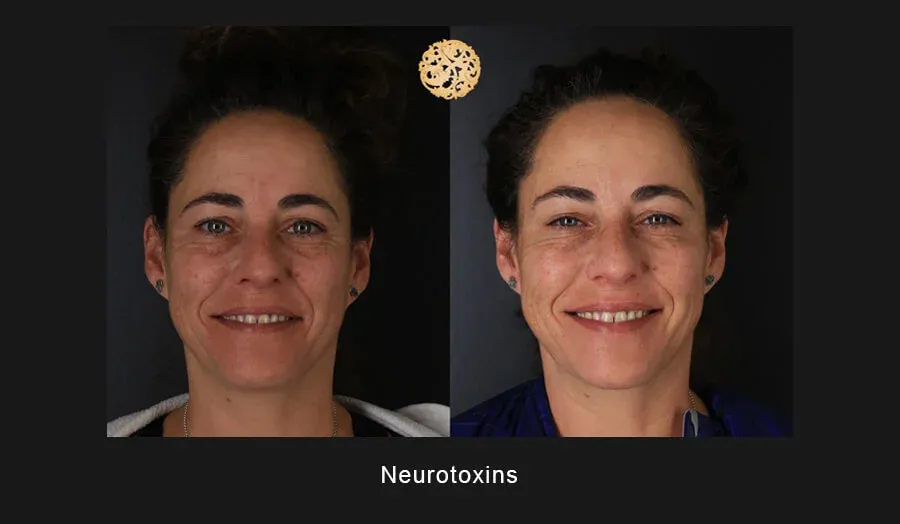 Neurotoxins Before & After