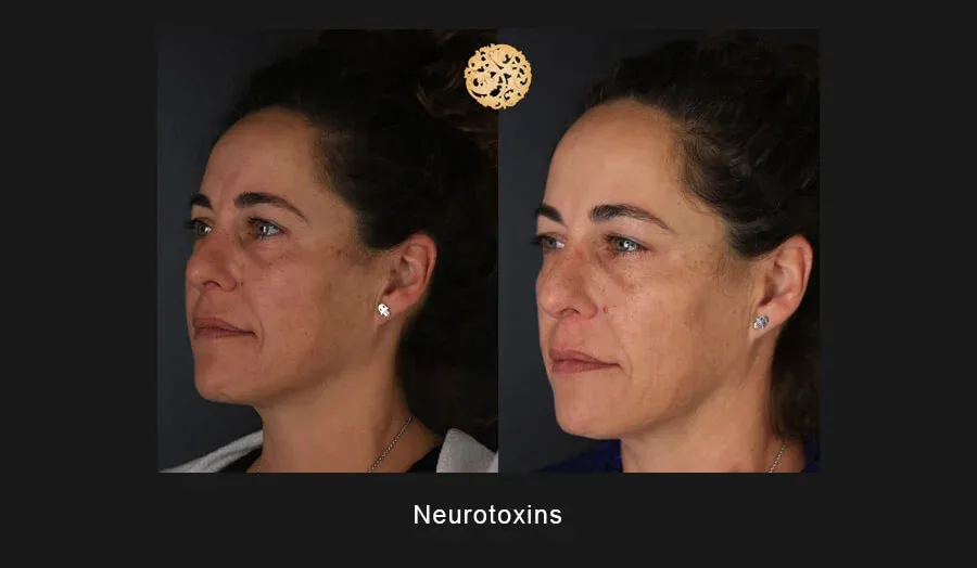 Neurotoxins Before & After