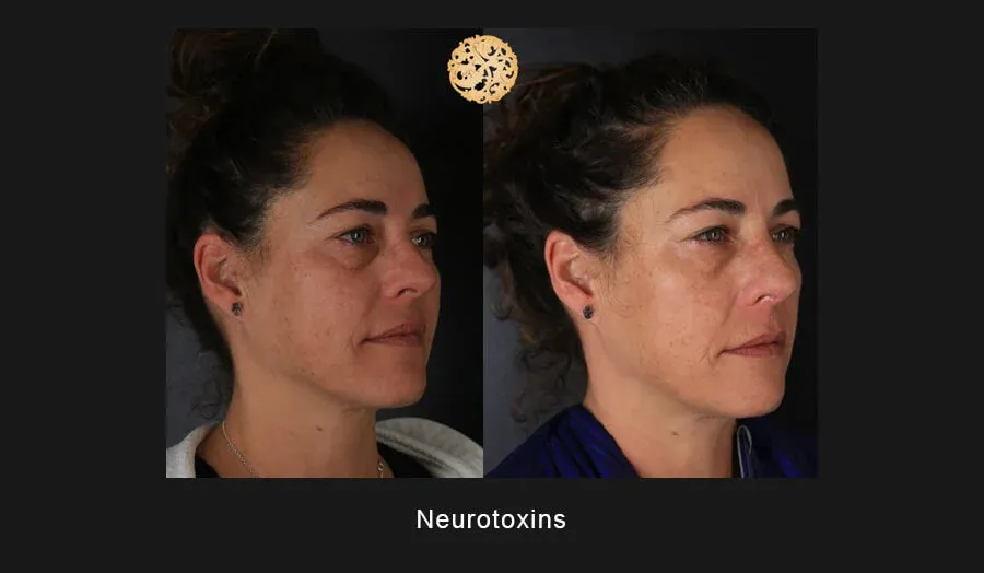 Neurotoxins Before & After