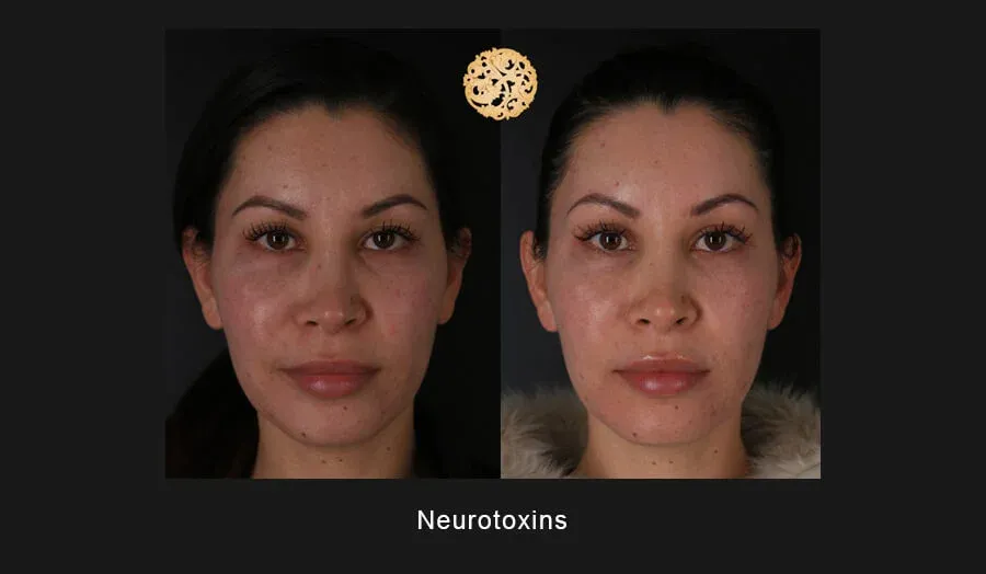 Neurotoxins Before & After