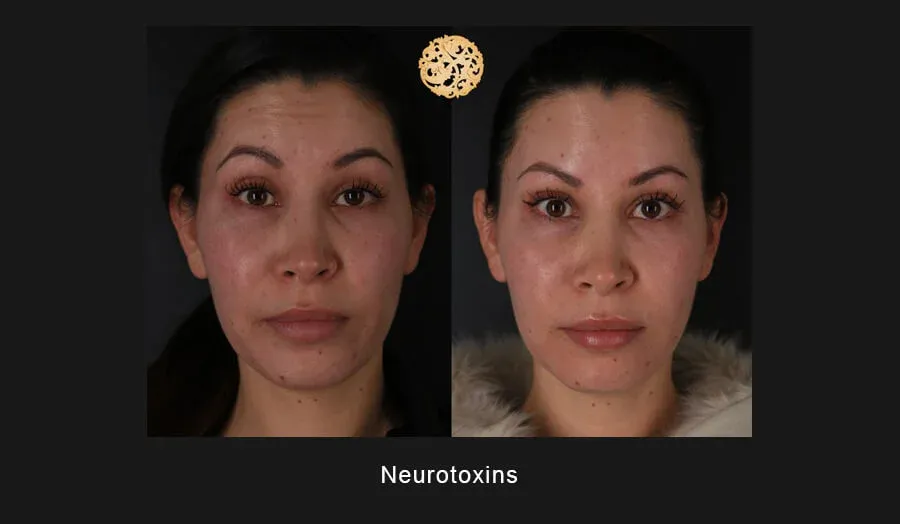 Neurotoxins Before & After