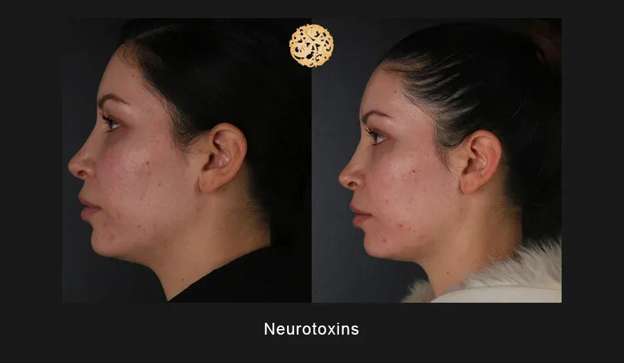 Neurotoxins Before & After