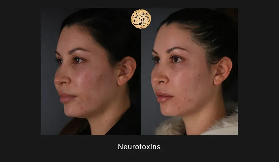 Neurotoxins Before & After