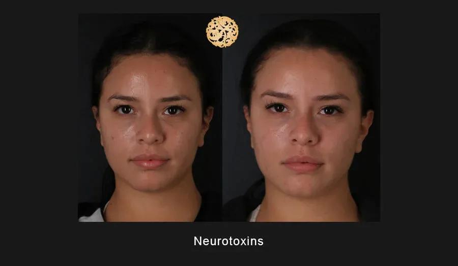 Neurotoxins Before & After