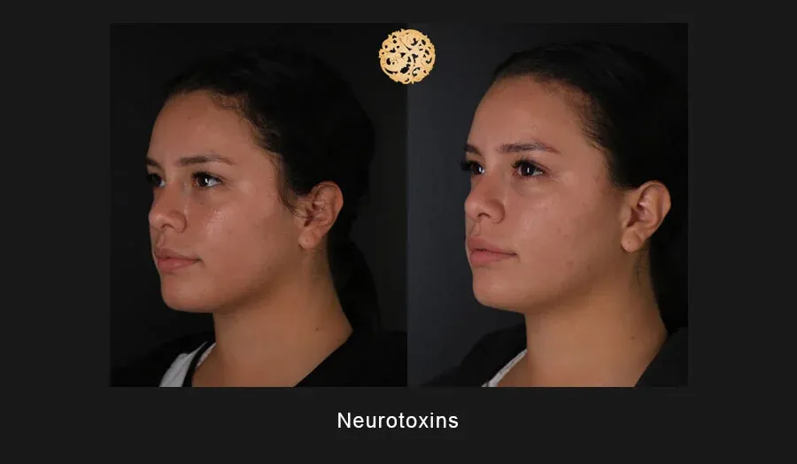 Neurotoxins Before & After