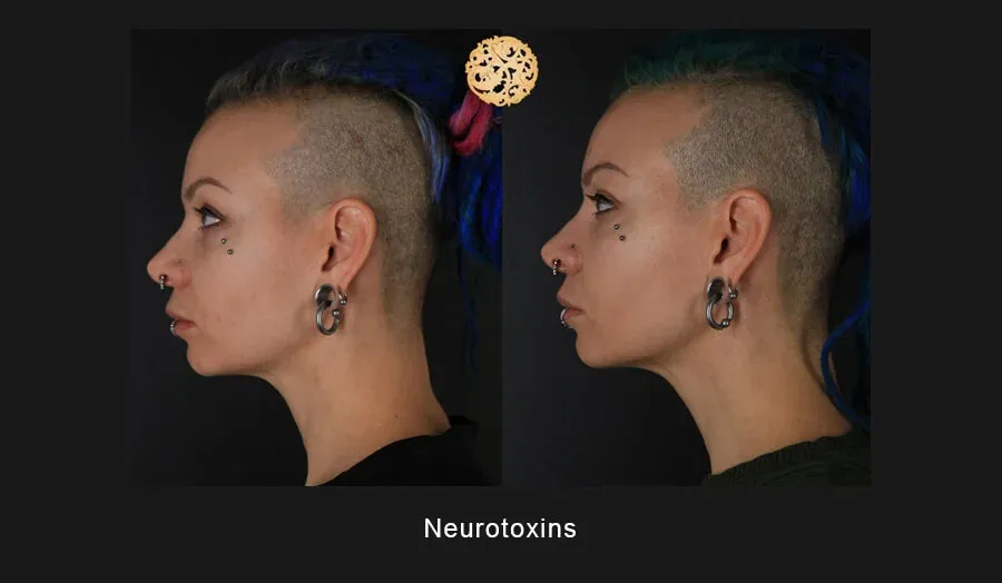 Neurotoxins Before & After