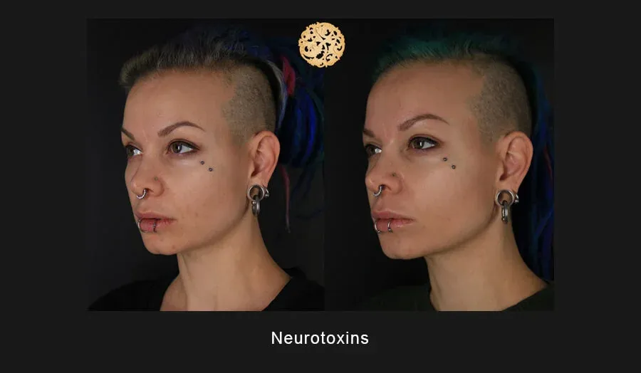 Neurotoxins Before & After
