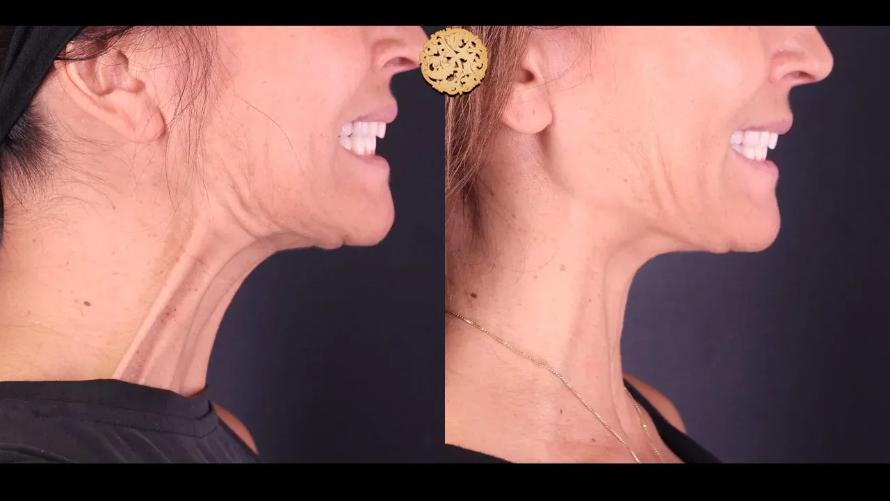 Neurotoxins Before & After