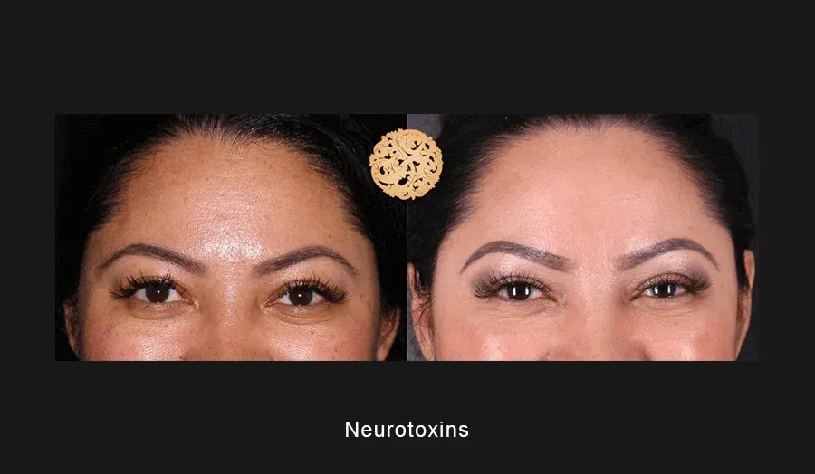 Neurotoxins Before & After