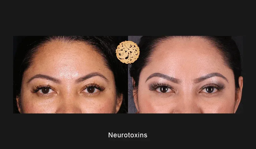 Neurotoxins Before & After