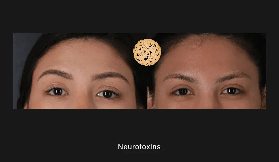 Neurotoxins Before & After