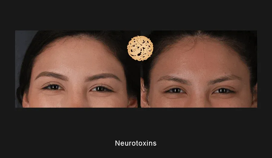 Neurotoxins Before & After