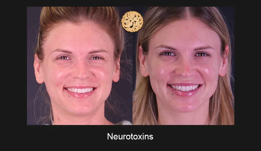Neurotoxins Before & After
