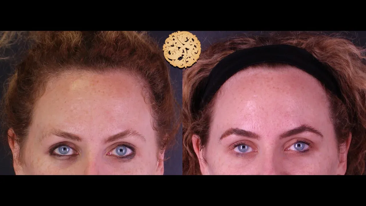 Neurotoxins Before & After