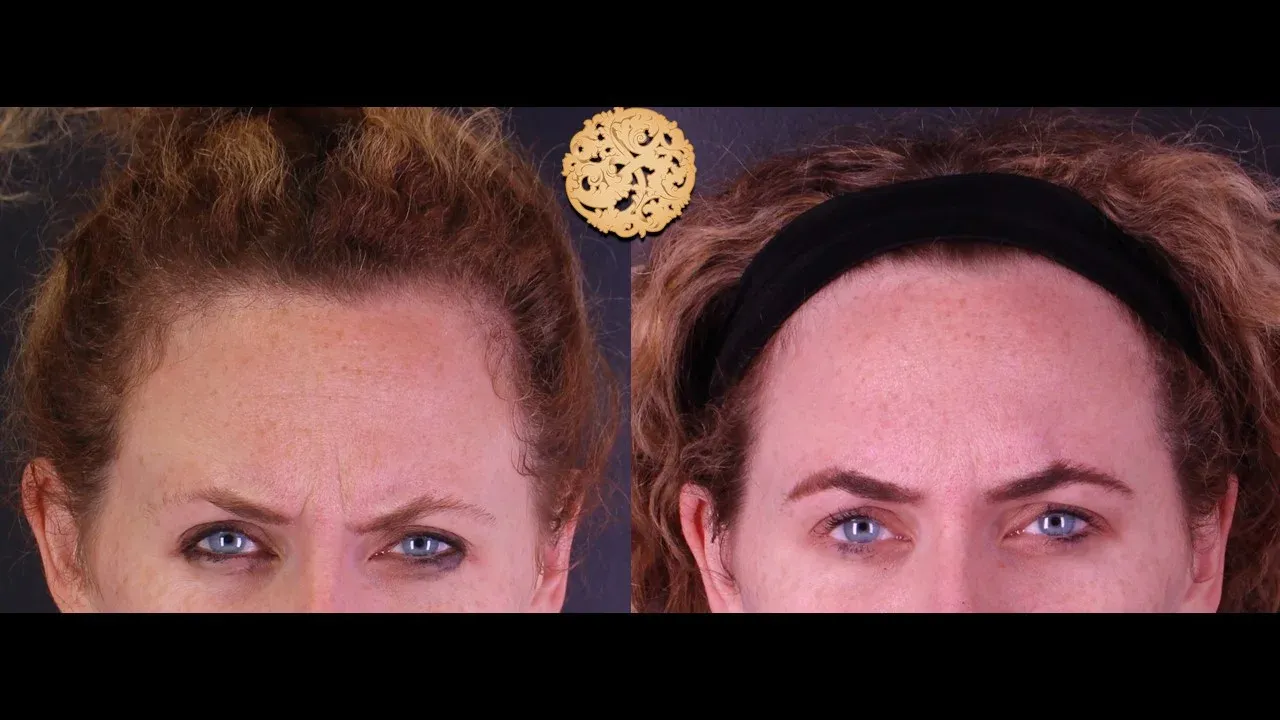 Neurotoxins Before & After