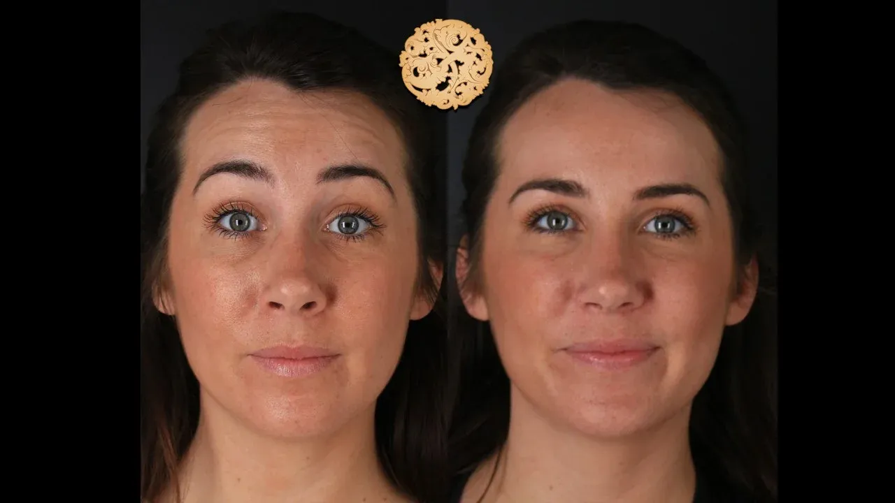 Neurotoxins Before & After