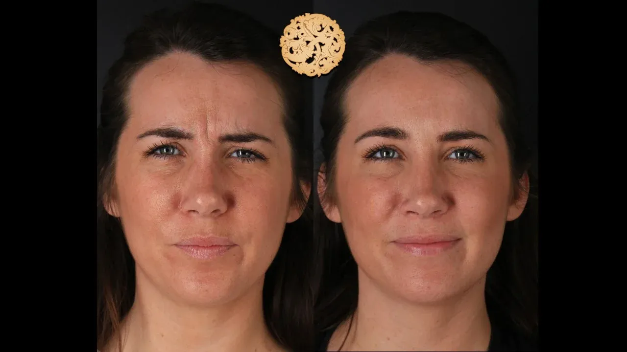 Neurotoxins Before & After