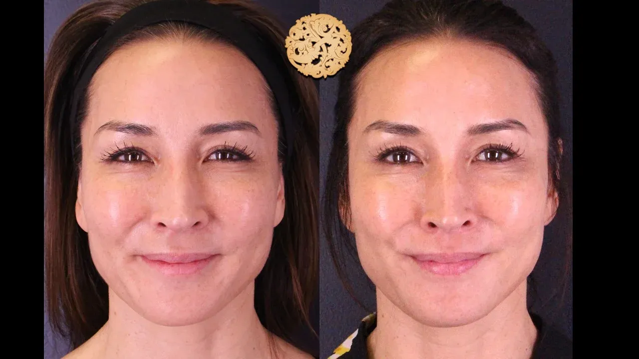 Neurotoxins Before & After