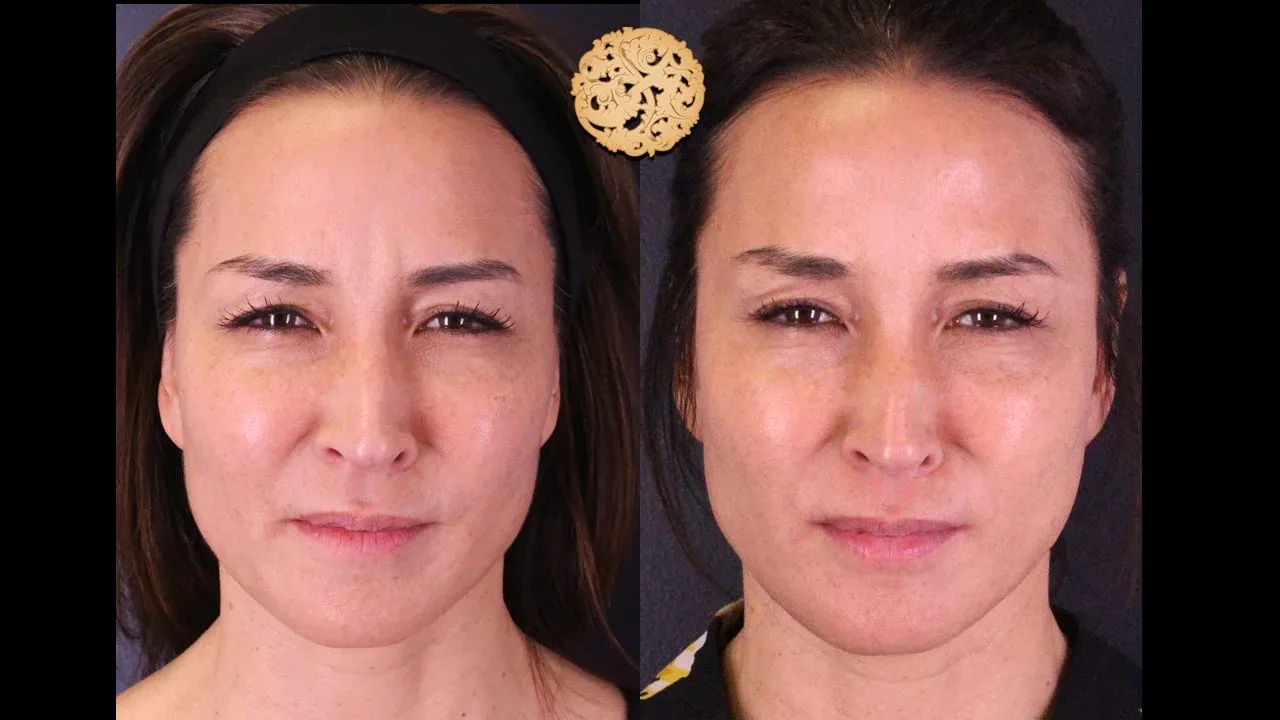 Neurotoxins Before & After