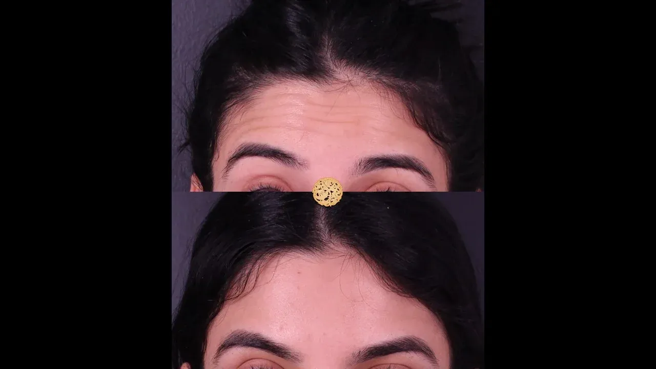 Neurotoxins Before & After