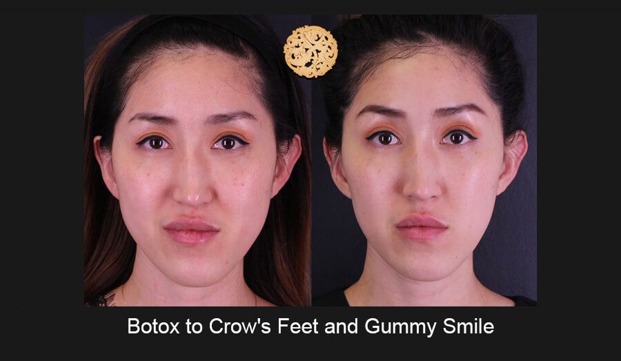 Neurotoxins Before & After