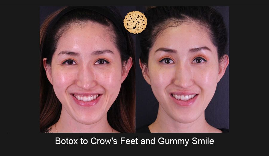 Neurotoxins Before & After