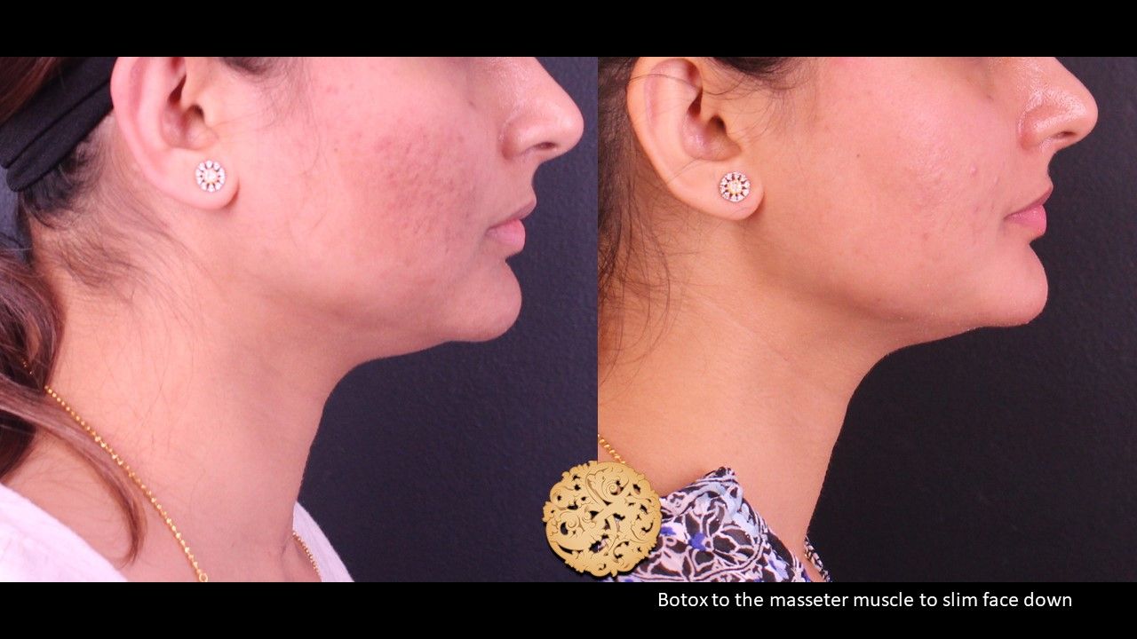 Neurotoxins Before & After