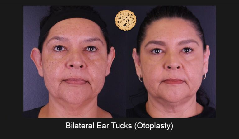 Earlobe Reconstruction Before & After