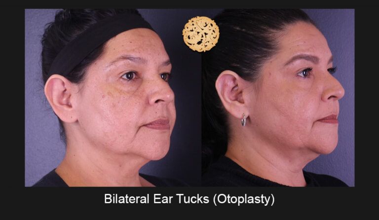 Earlobe Reconstruction Before & After
