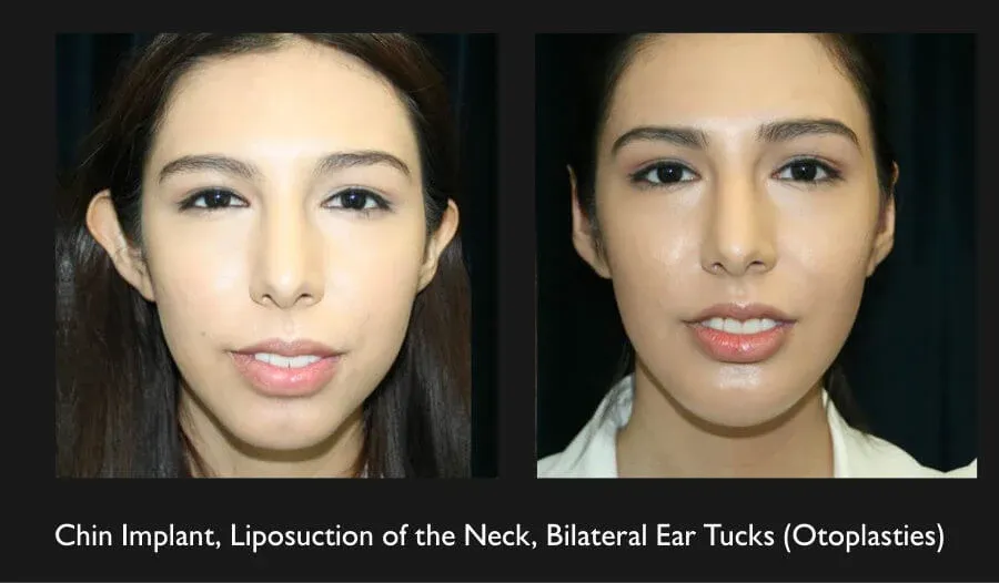 Earlobe Reconstruction Before & After