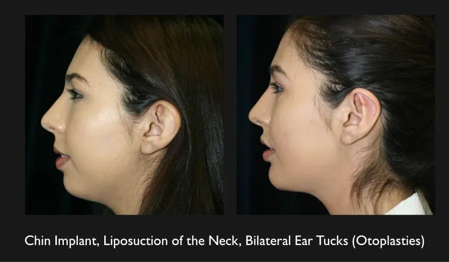 Earlobe Reconstruction Before & After