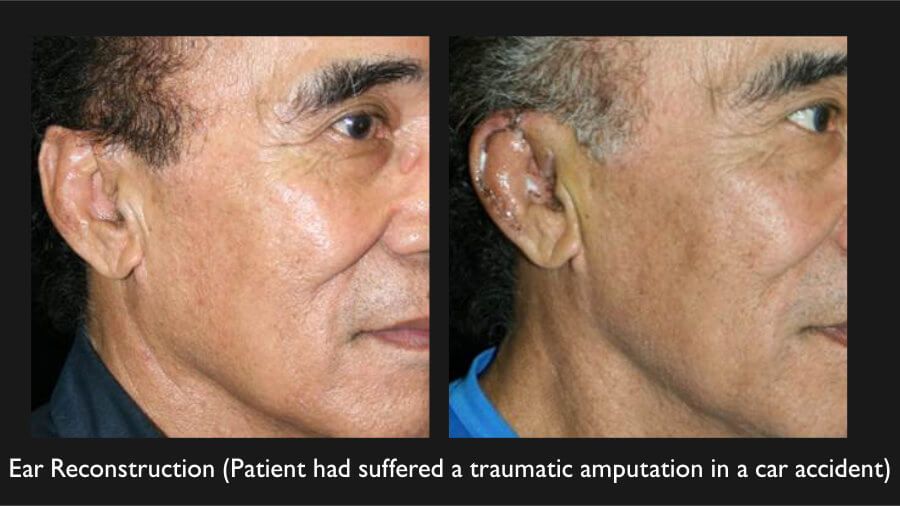 Earlobe Reconstruction Before & After