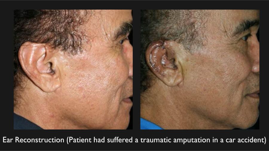 Earlobe Reconstruction Before & After