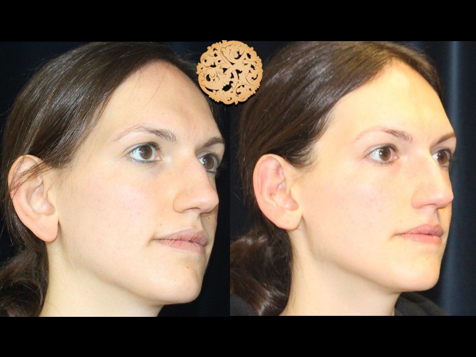 Earlobe Reconstruction Before & After