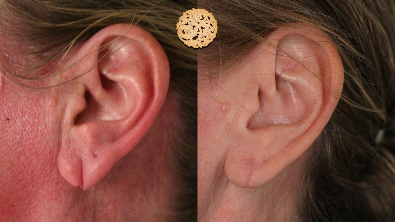 Earlobe Reconstruction Before & After