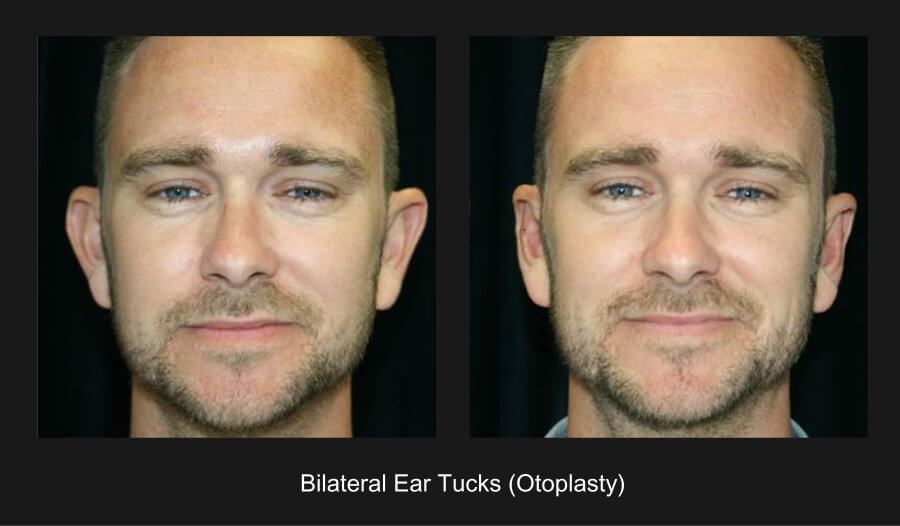 Ear Reconstruction Before & After