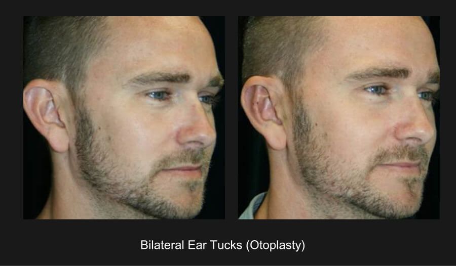 Ear Reconstruction Before & After