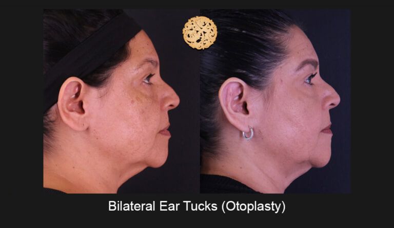 Ear Reconstruction Before & After
