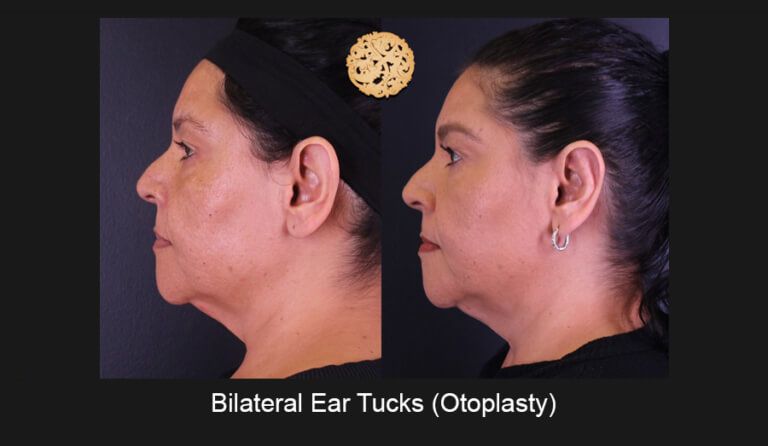 Ear Reconstruction Before & After