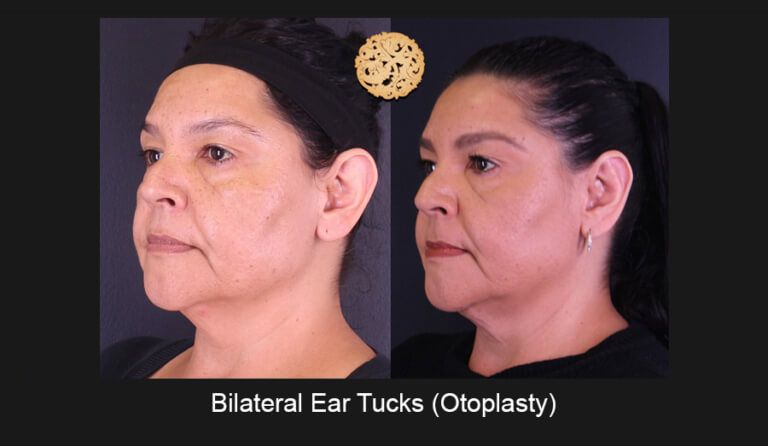 Ear Reconstruction Before & After