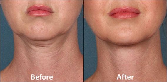 Double Chin Treatment Before & After