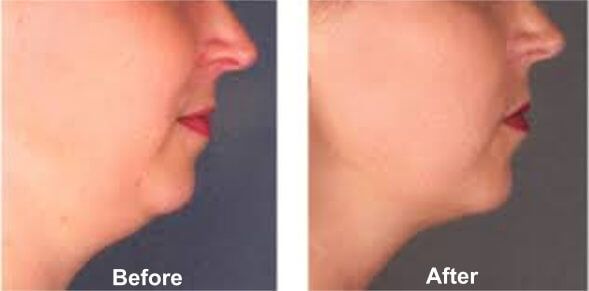 Double Chin Treatment Before & After