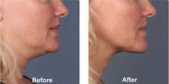 Double Chin Treatment Before & After